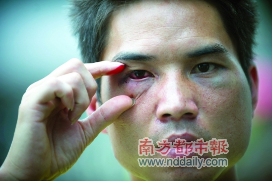 皮某身上多處被打傷。