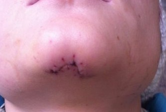 年輕女子被撞毀容 肇事方提醒藥費(fèi)超限不給報(bào)